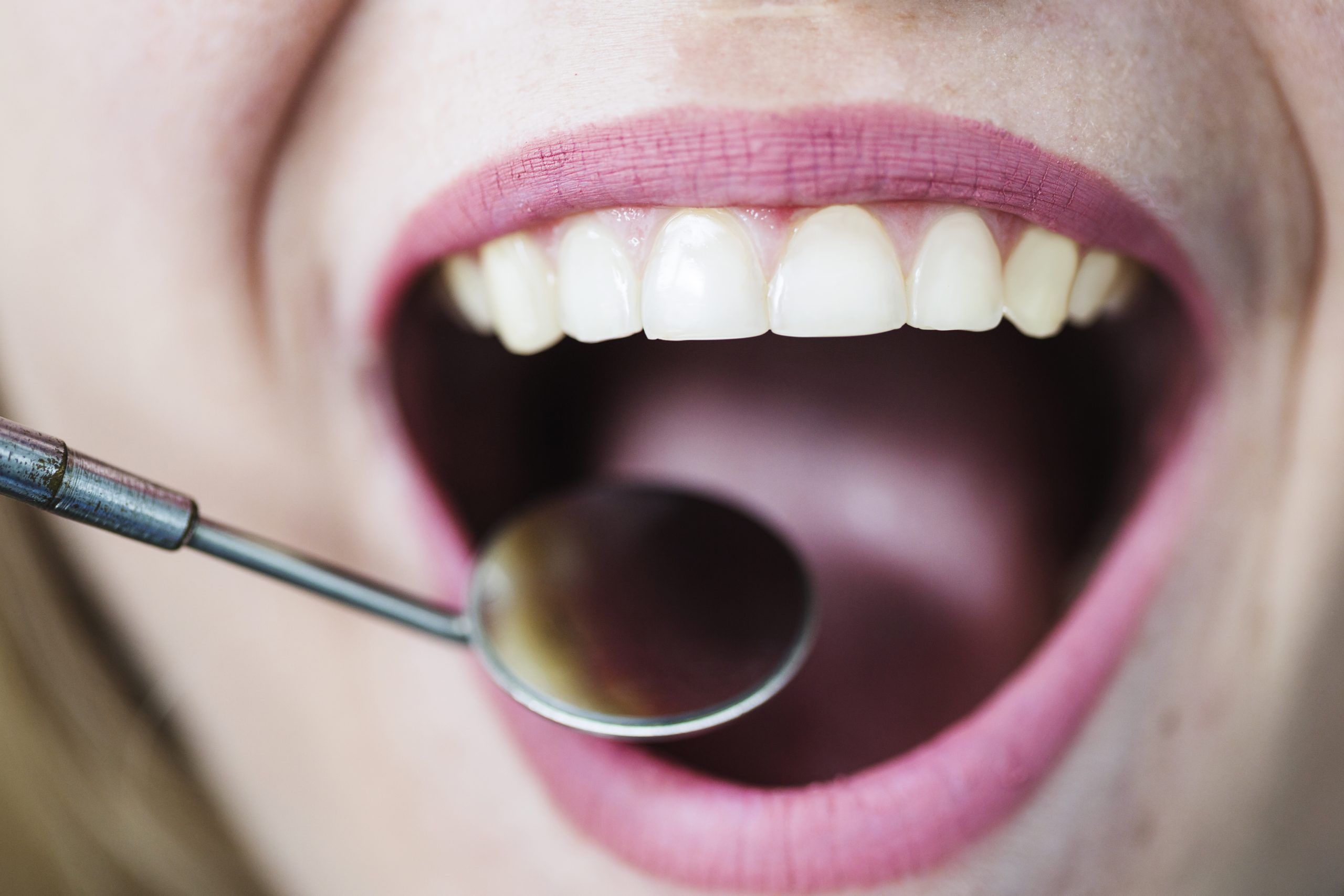 Diş Eti Çekilmesi: Nedenleri, Belirtileri ve Tedavi Seçenekleri