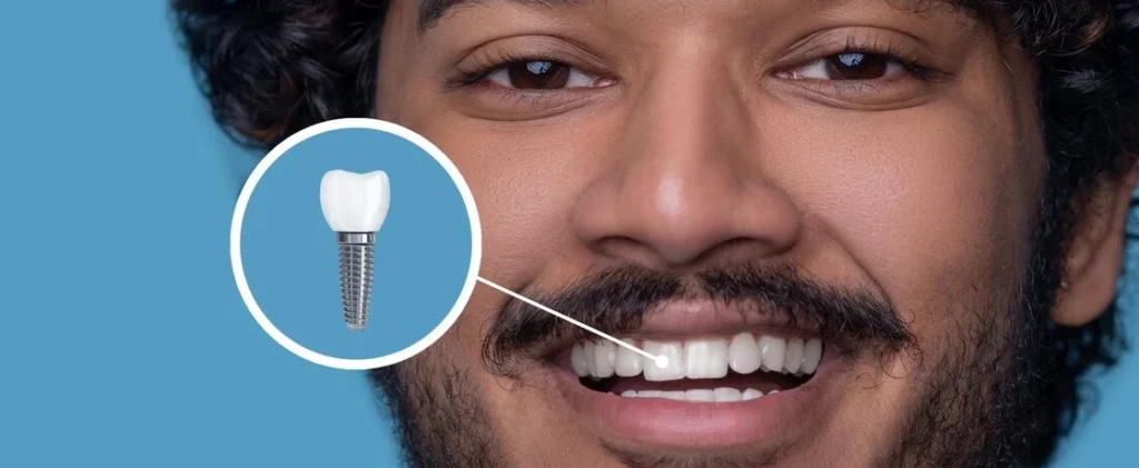 İmplant Sonrası İyileşme Sürecinde Kemik Kaybı Korkusu: Ne Normal, Ne Değil?