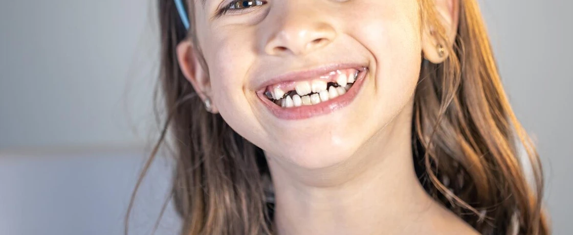 Çocuklarda Diş Teli Tedavisi