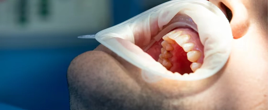 Diş Eti Kanserinin Belirtileri ve Erken Teşhis