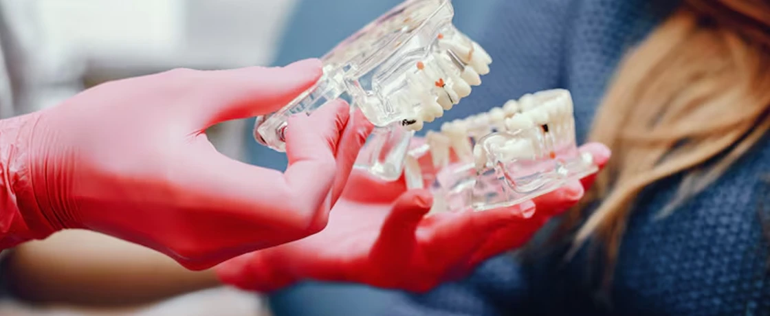 Diş İmplantı mı, Köprü mü? Hangisi Daha Avantajlı?