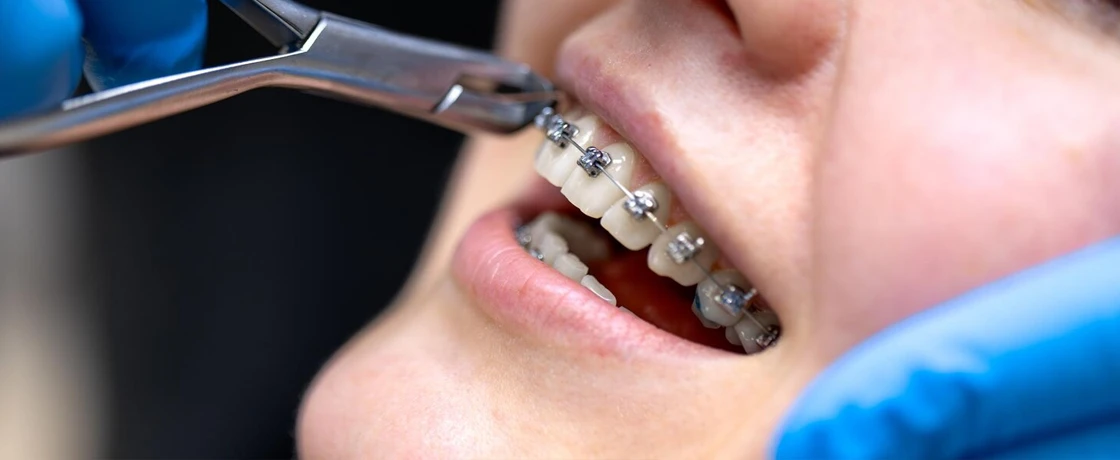 Diş Teli Çeşitleri ve Avantajları