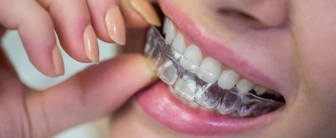 Diş Teli mi, Şeffaf Plak mı? Hangisi Daha İyi?