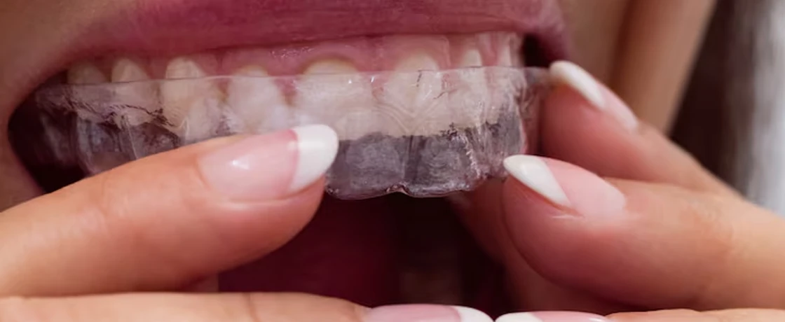 Invisalign Tedavisi: Avantajları ve Süreci