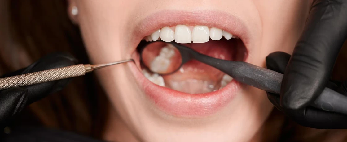 Kırık Diş Tedavisi: Hangi Yöntemler Kullanılır?