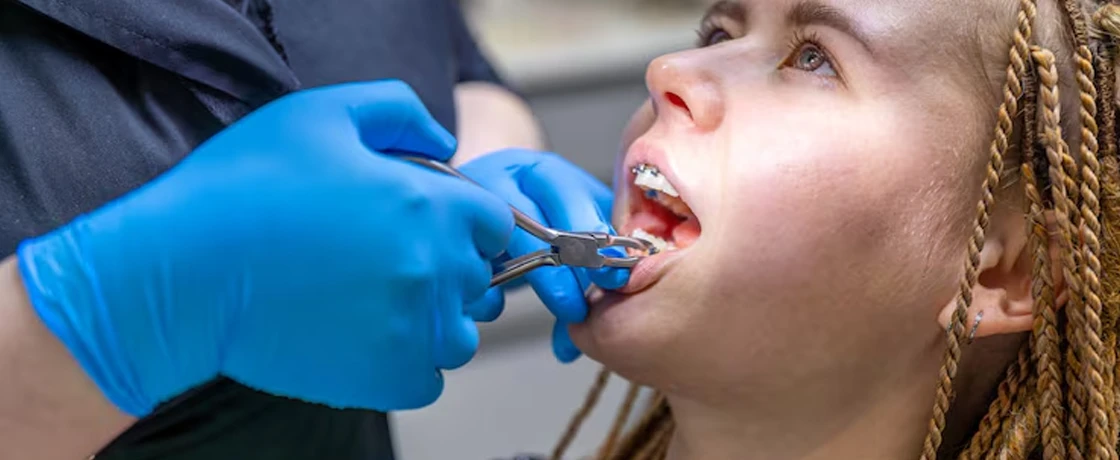 Ortodontik Tedavi Süreci: Ne Beklemelisiniz?